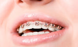 ¡Mejora tu sonrisa! Ortodoncia (colocación de minibrackets nuevos) + Limpieza dental